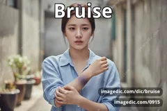 bruise