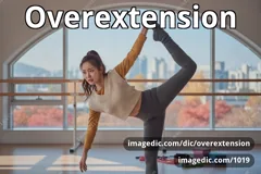overextension